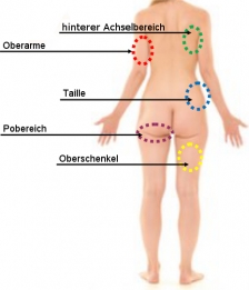 Nur einige der Zonen auf der Körper-Rückseite bei welchen die Kryolipolyse erfolgreich eingesetzt werden kann.