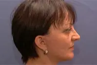 Gedanken vor der Operation - Facelift 2