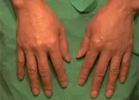 Gedanken vor der Operation - Handverjuengung