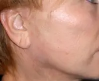 Gedanken vor der Operation - Hautpeeling