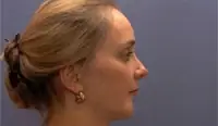 Gedanken vor der Operation - Kinnkorrektur 1