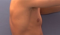 Gedanken vor der Operation - Männliche Brust