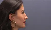 Gedanken vor der Operation - Nasenkorrektur 1