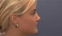 Gedanken vor der Operation - Nasenkorrektur 4